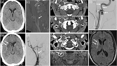 Case report: A complicated course of Collet-Sicard syndrome after internal carotid artery dissection and lenticulo-striatal artery infarction